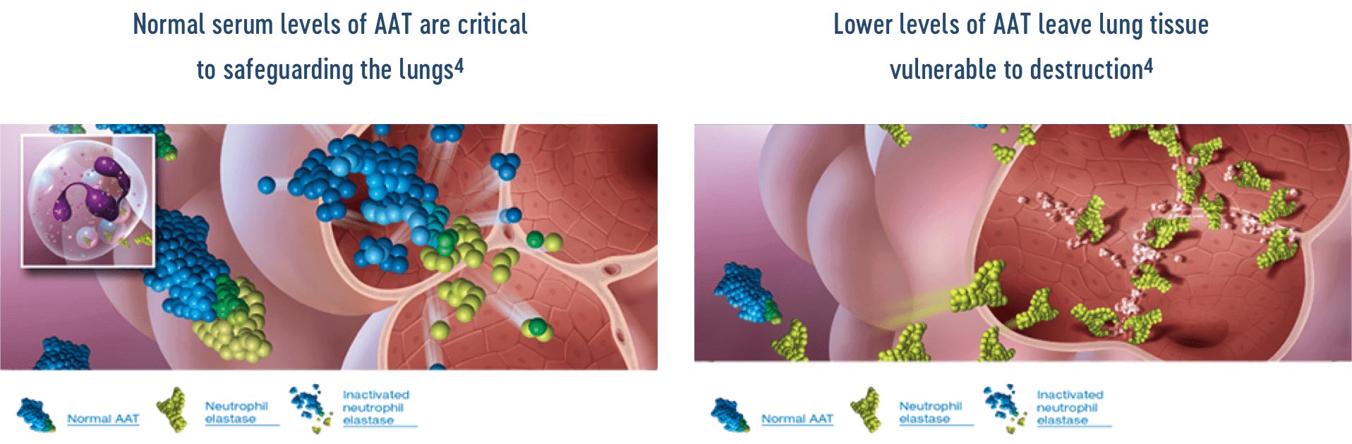 Normal serum levels of AAT snares, flips, and deactivates neutrophil elastase. Lung tissue being destroyed because of the lower levels of AAT.